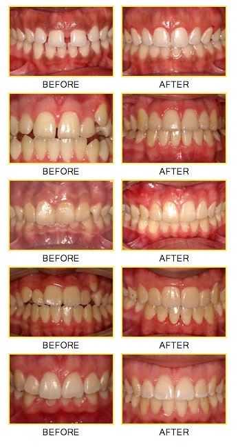 Teeth before and after braces