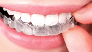 Edmonton braces, invisible braces from Embrace Orthodontics