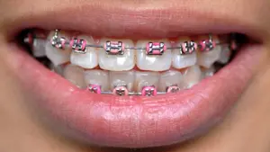 Embrace Orthodontics provides metal braces