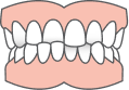 Clear aligners for crossbite correction in Edmonton