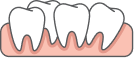 Clear aligners for crowded teeth in Edmonton