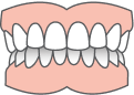 Clear aligners for overbite correction in Edmonton