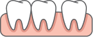 Clear aligners for spacing and gaps between teeth in Edmonton